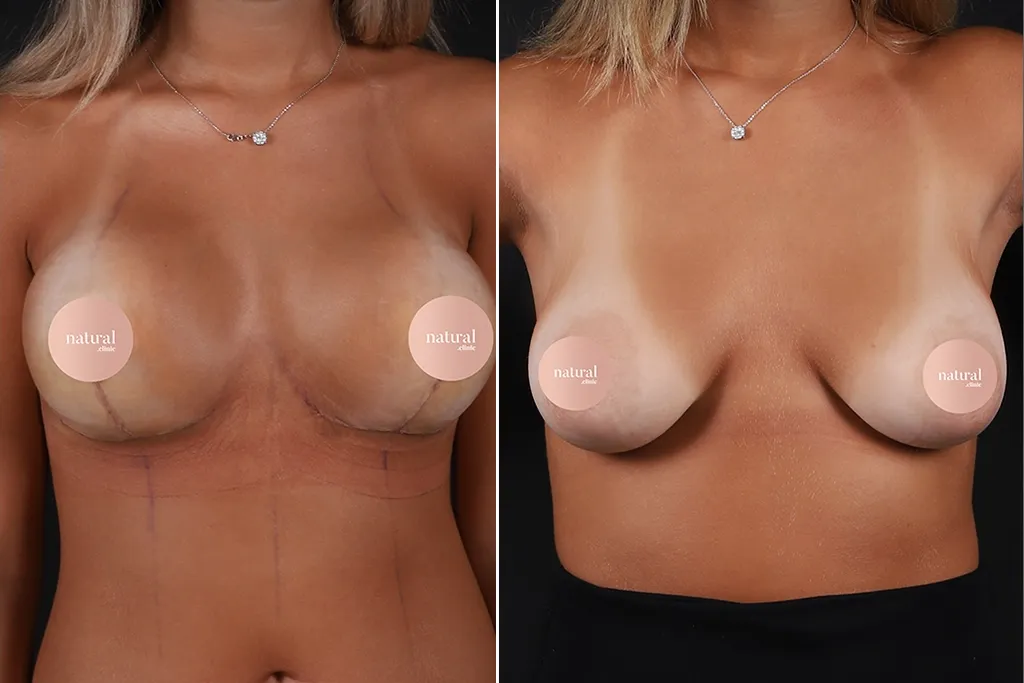 Breast Augmentation Before After In Turkey 25