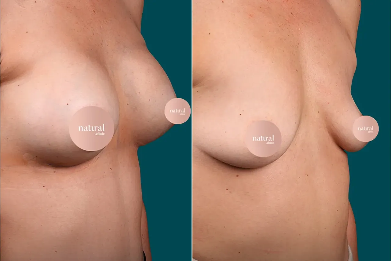 Breast Augmentation Before and After 3