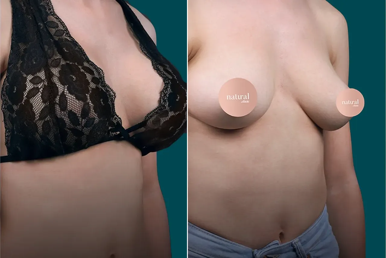 Breast Augmentation Before and After 4