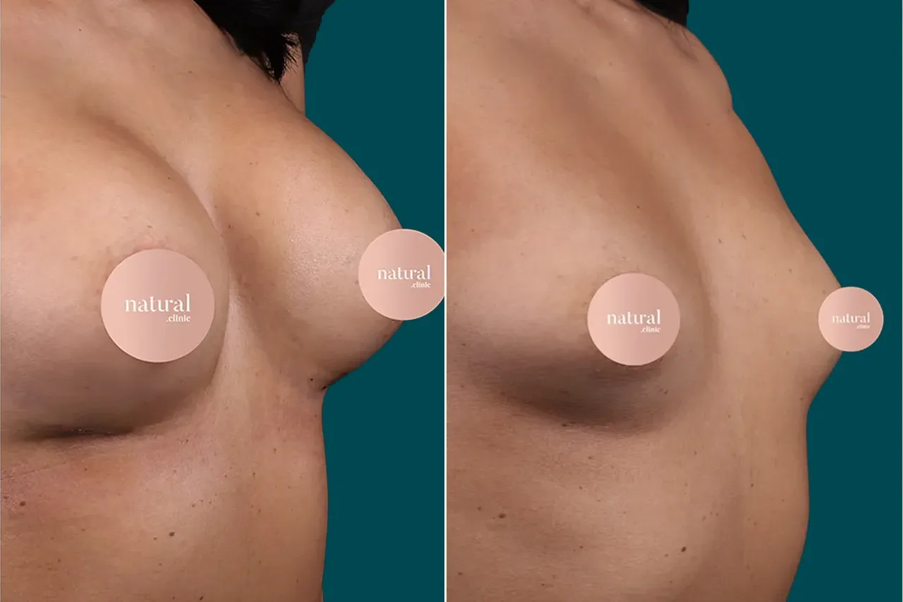 Breast Augmentation Before and After 6