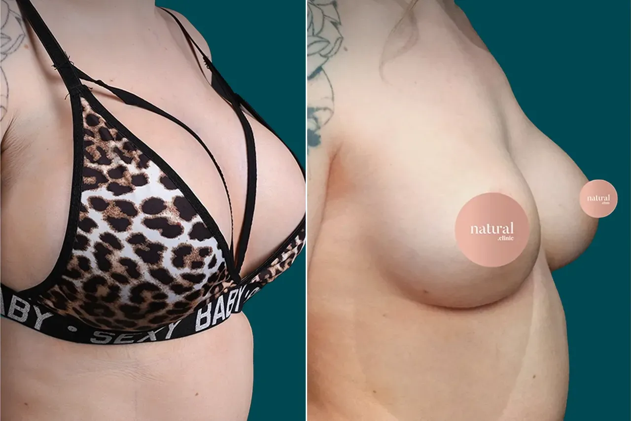 Breast Augmentation Before and After 7