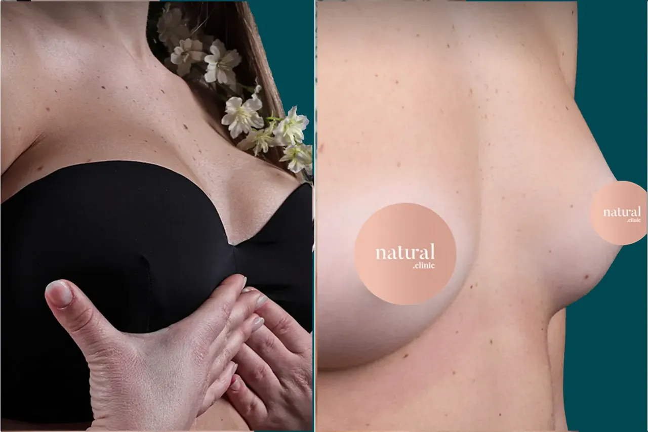 Breast Augmentation Before and After 8