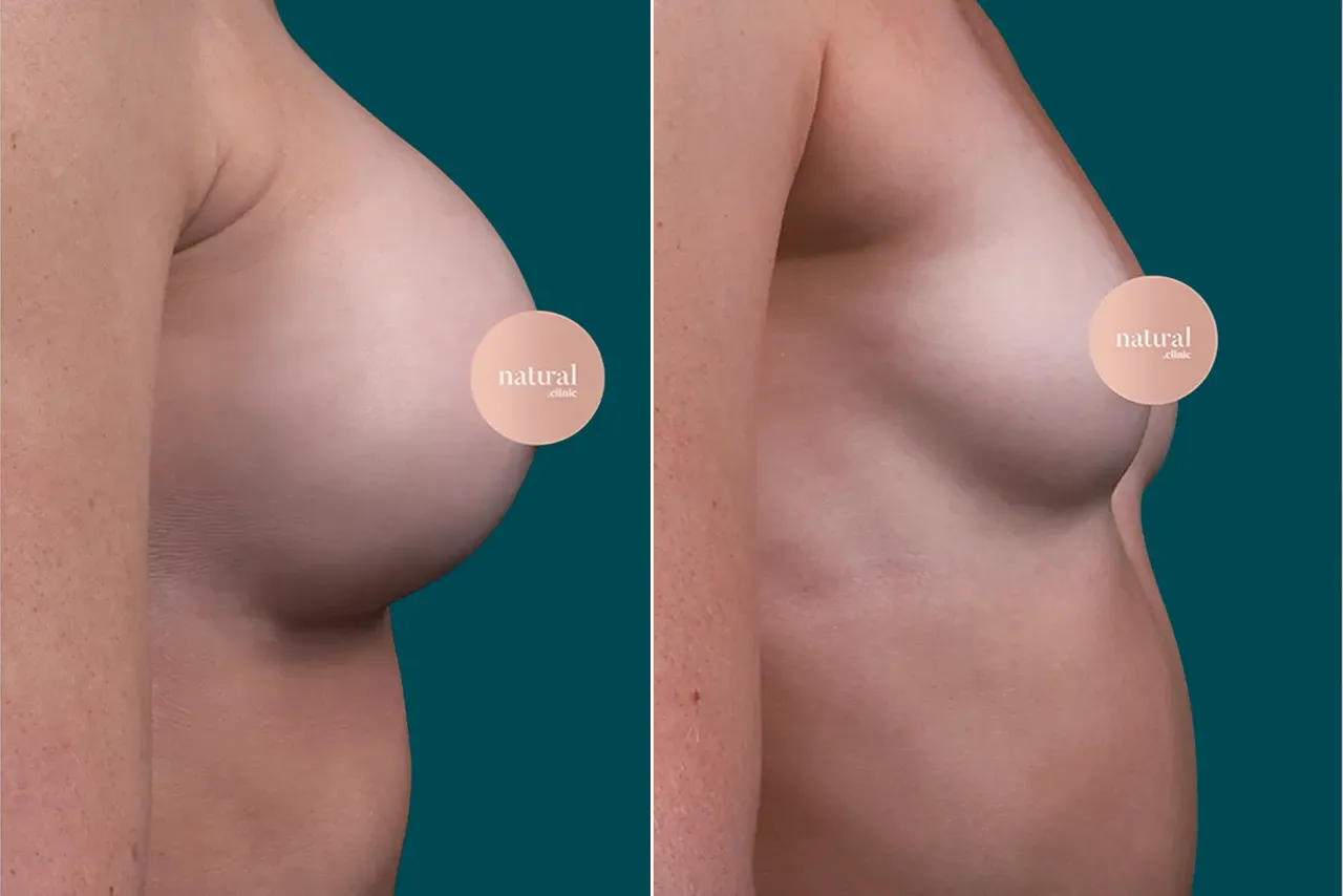 Breast Augmentation Before and After 9