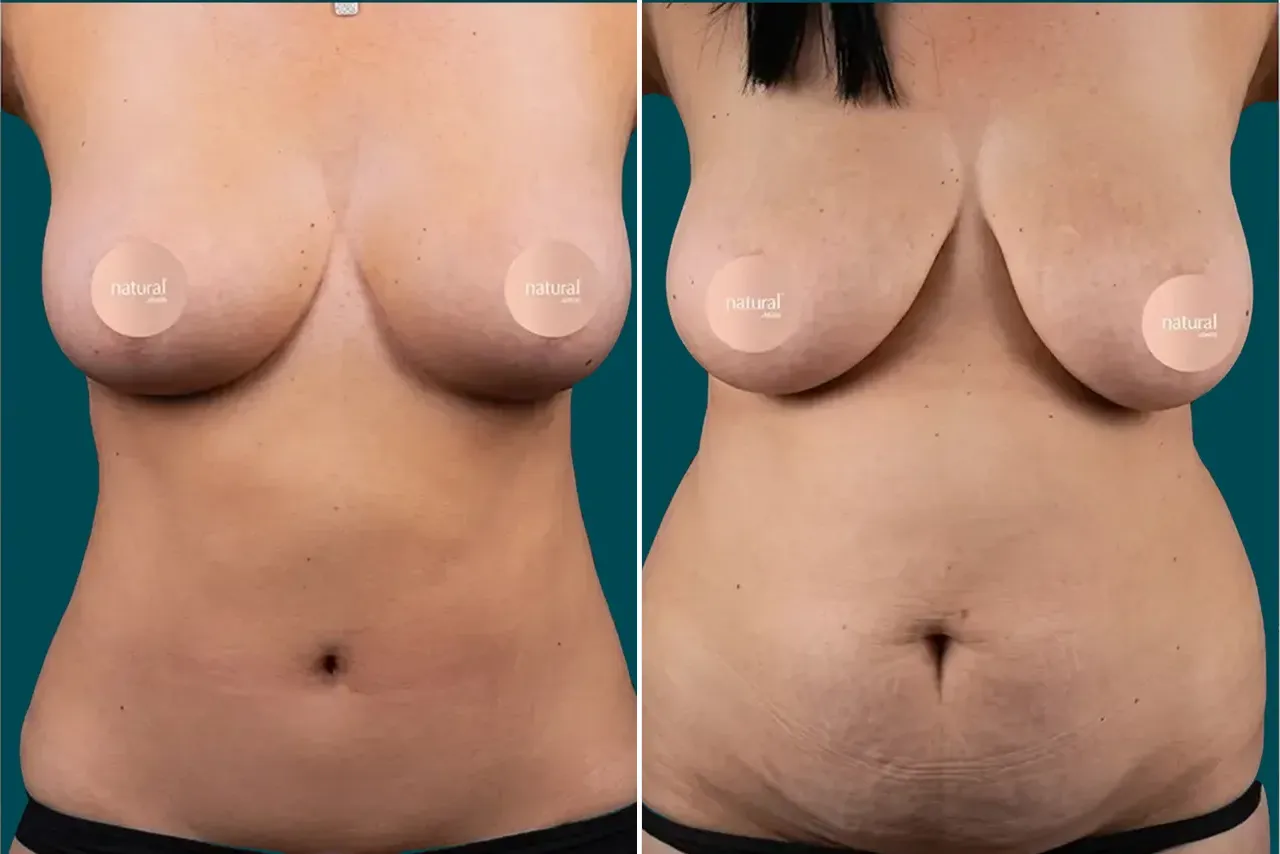 Breast Lift Before and After 1