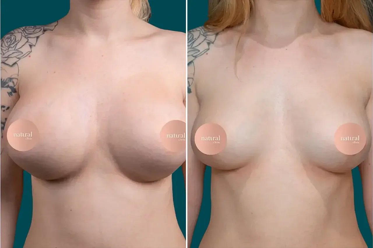 Breast Lift Before and After 3
