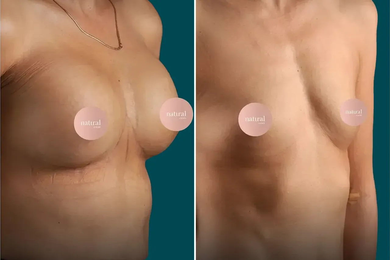 Breast Lift Before and After 4