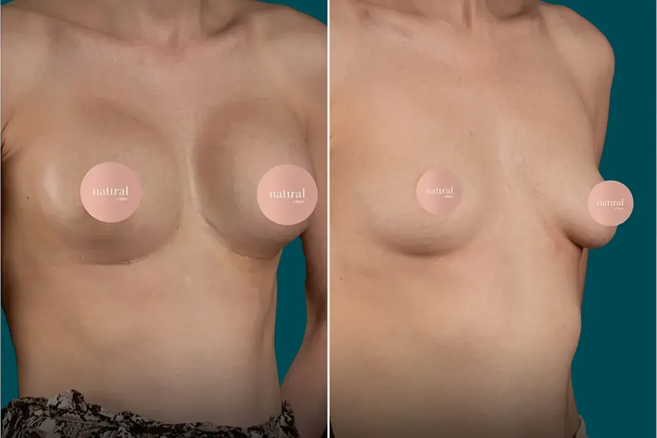 Breast Lift Before and After 5