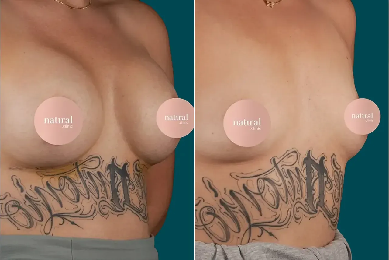 Breast Lift Before and After 6