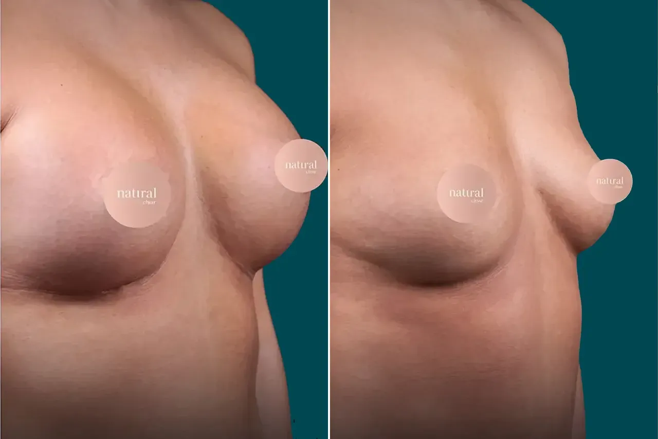 Breast Lift Before and After 7