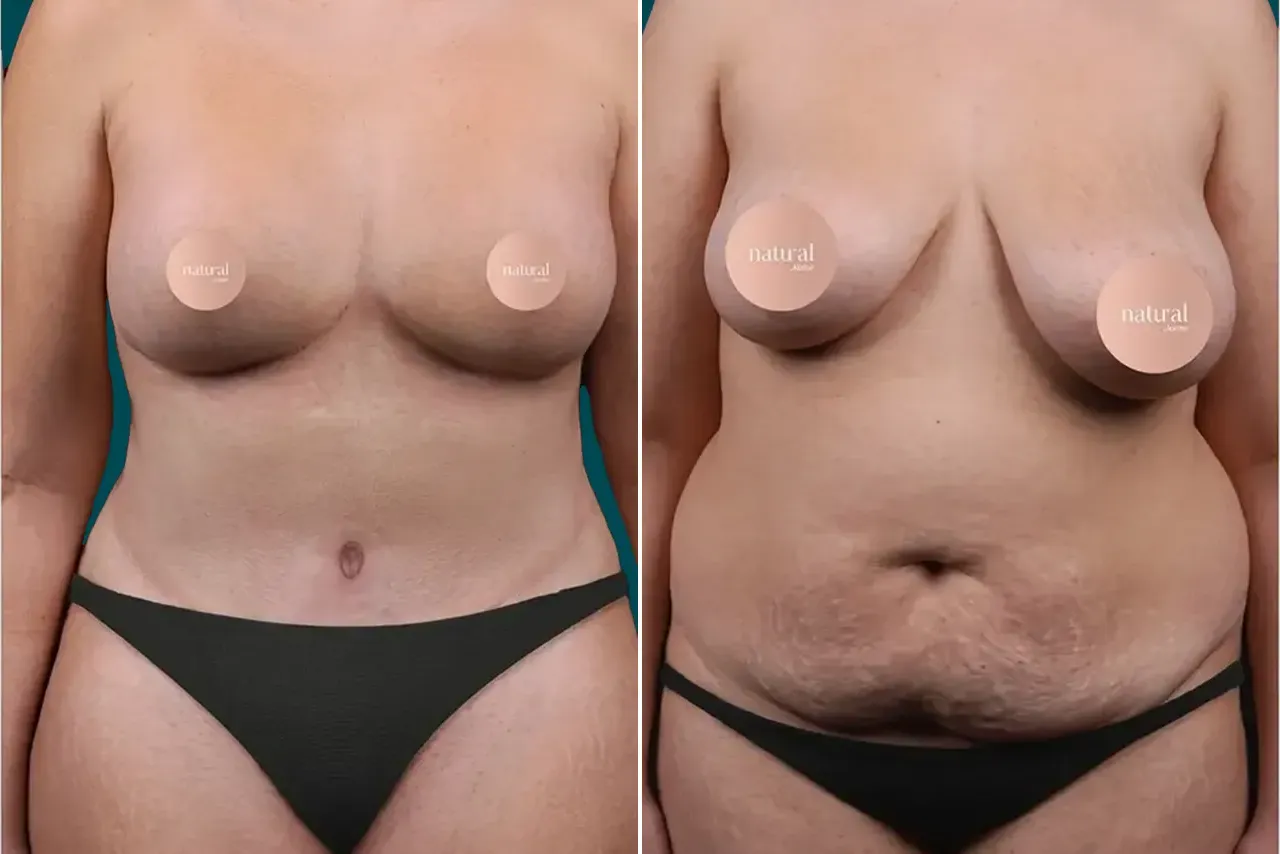 Breast Lift Before and After 8
