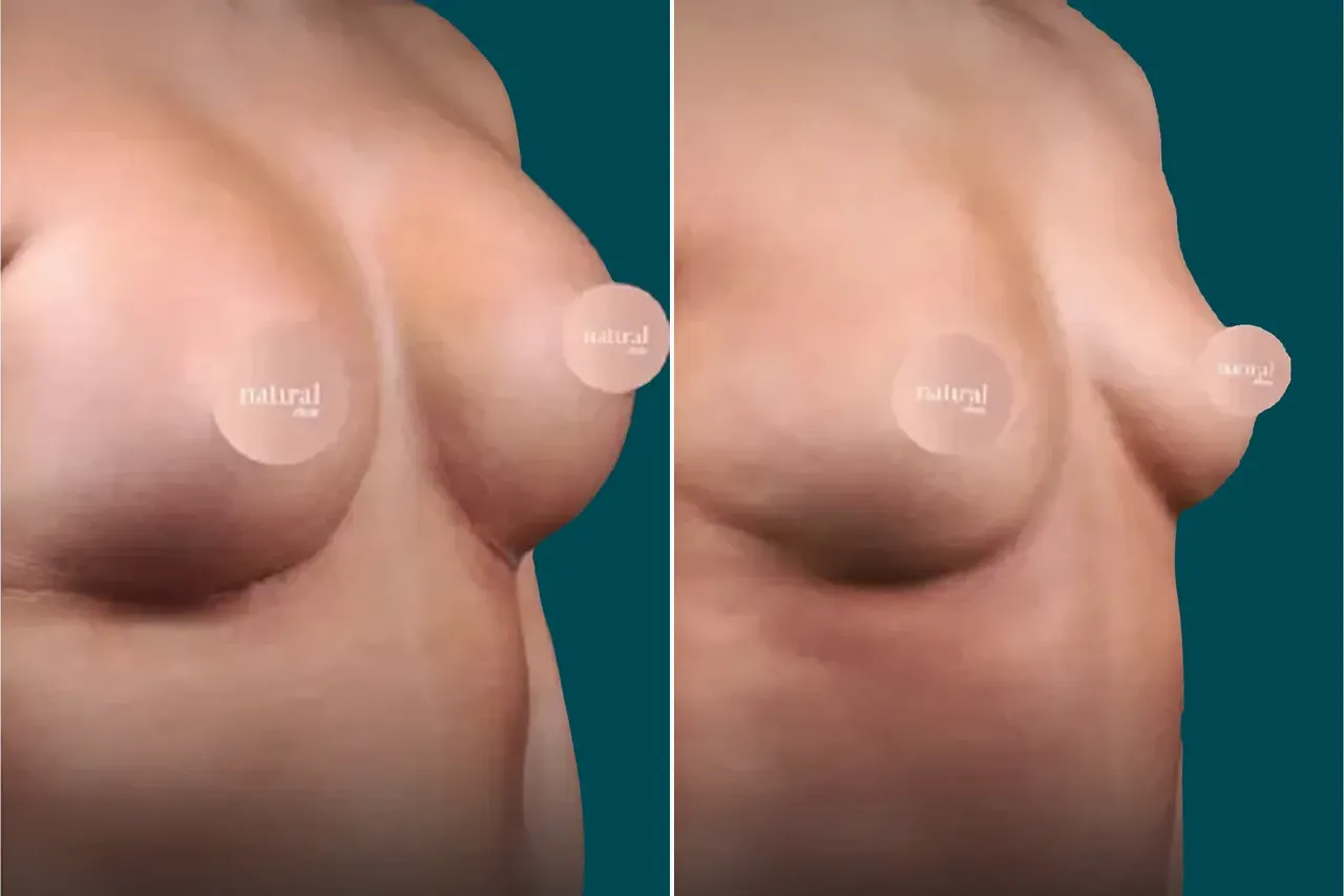 Breast Lift Before and After 9