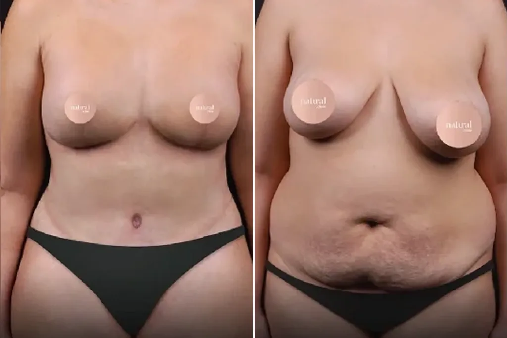 BreastLifting6