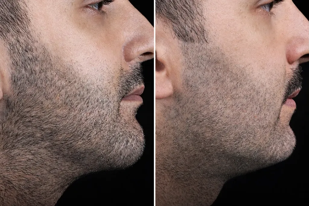 ChinLiposuction3