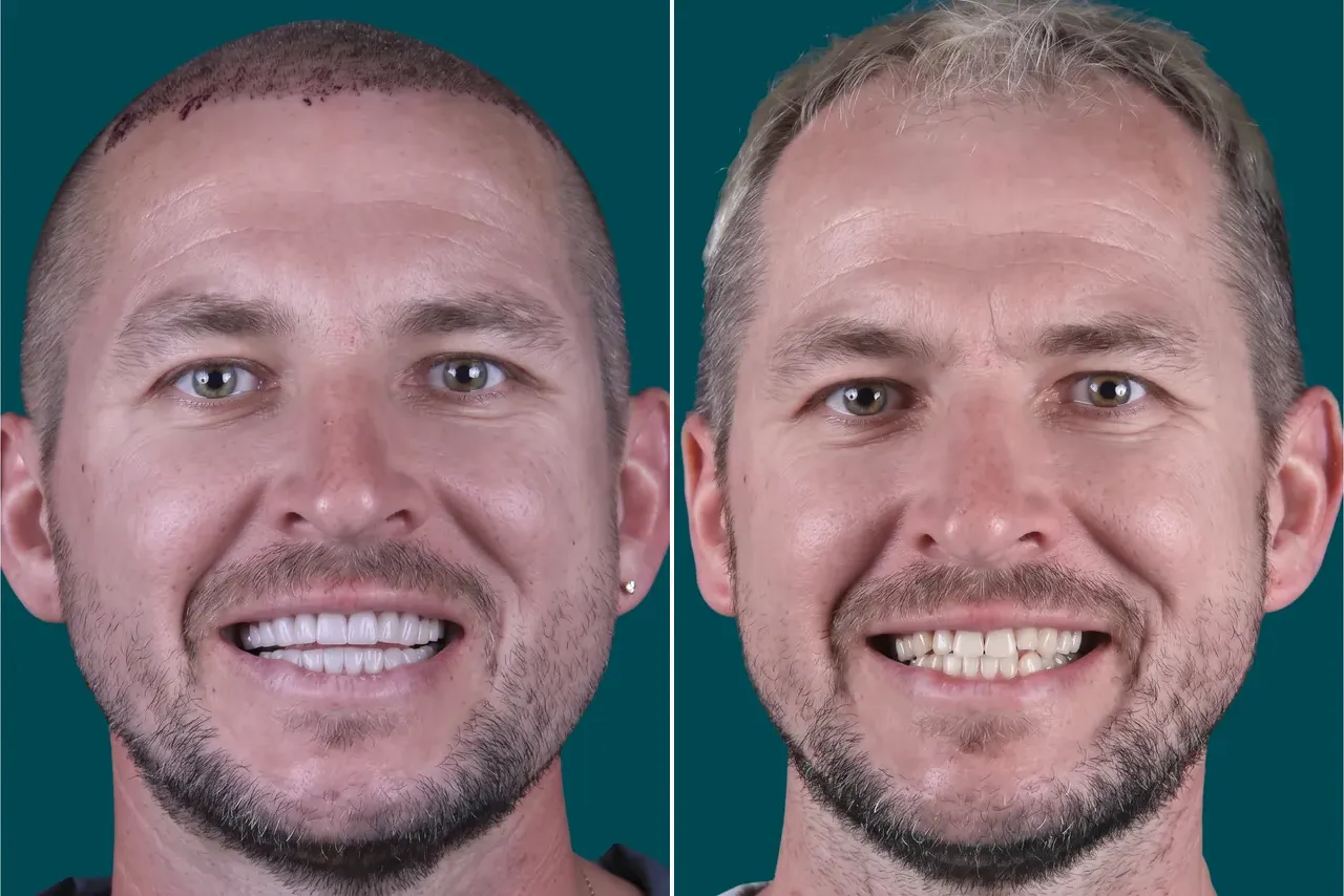 Dental Veneers-Composite Veneers 2