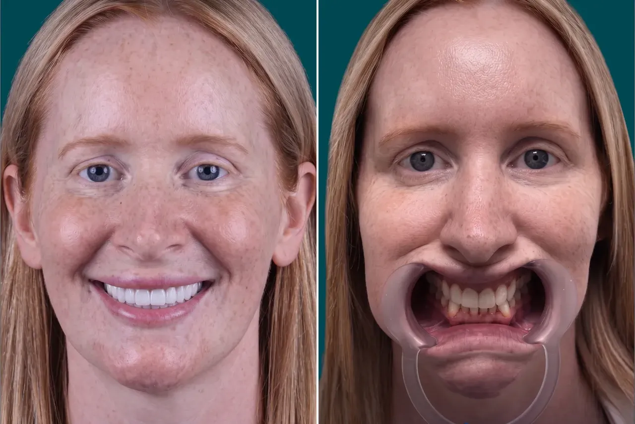 Dental Veneers-Composite Veneers 4