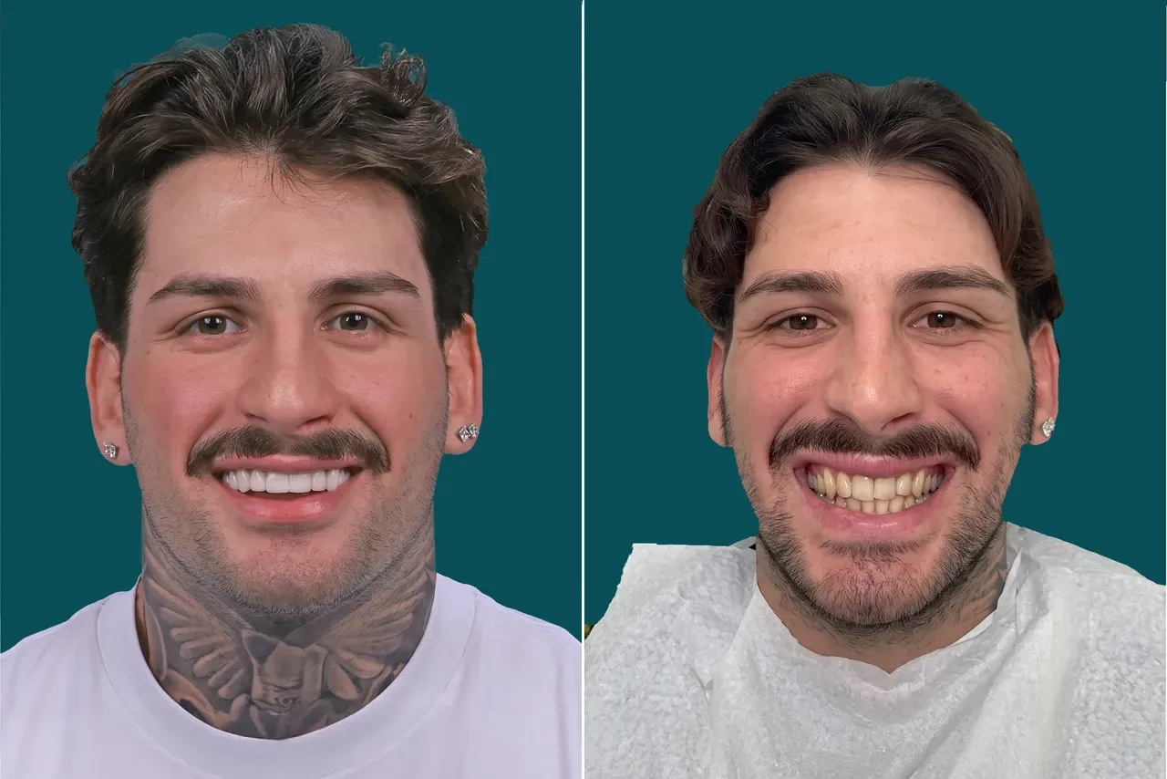 Dental-Veneers-Composite Veneers 1