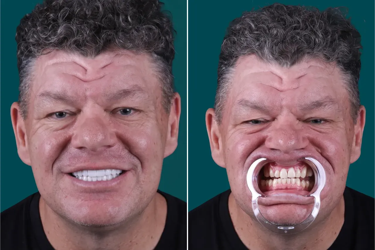 Dental Bridge 4