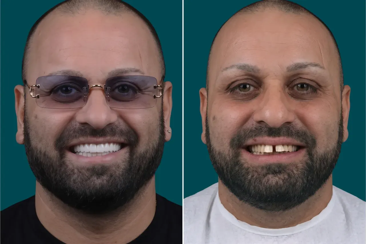 Dental-Crowns 2