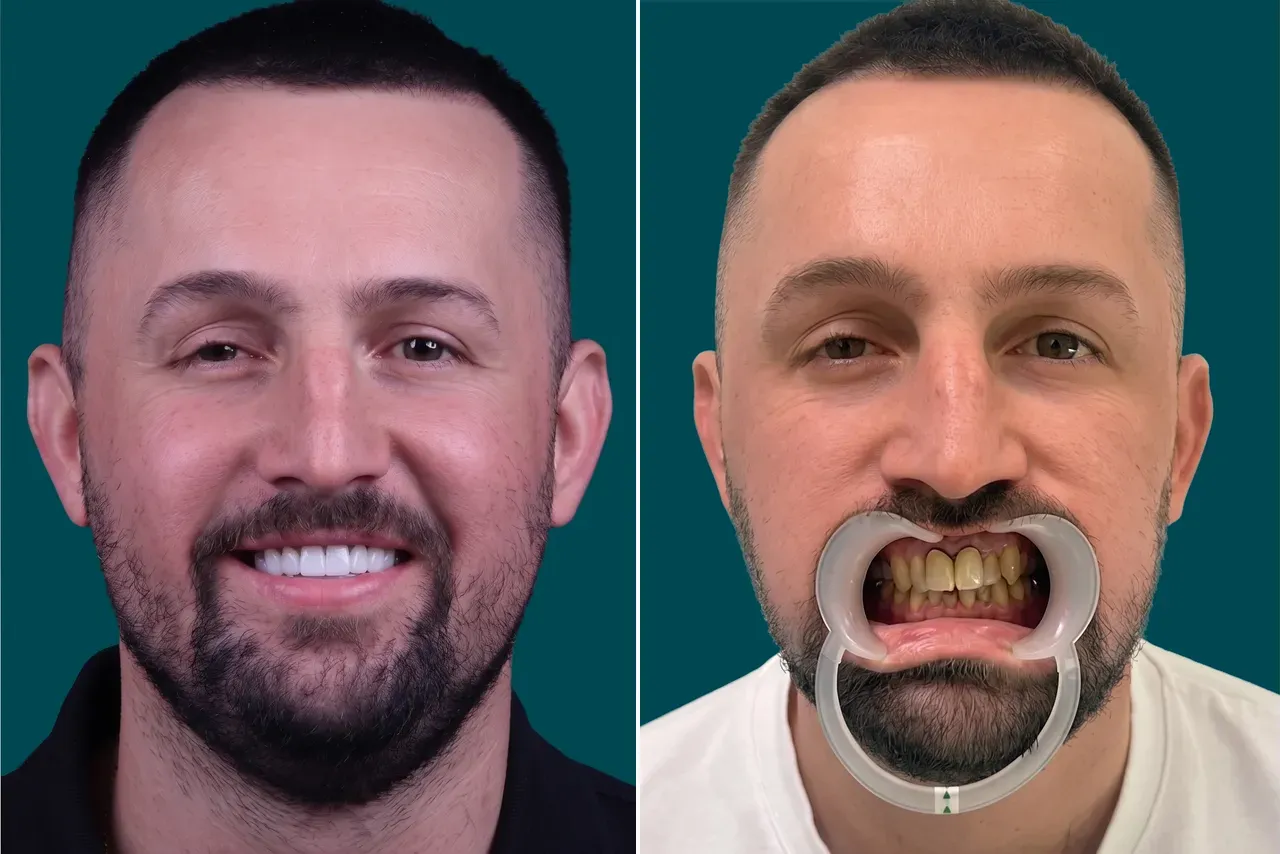 Dental-Crowns 3