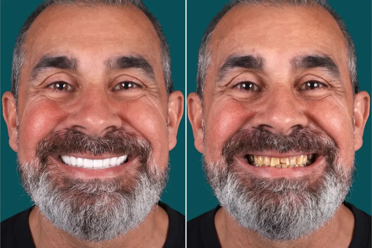 Dental-Crowns 1