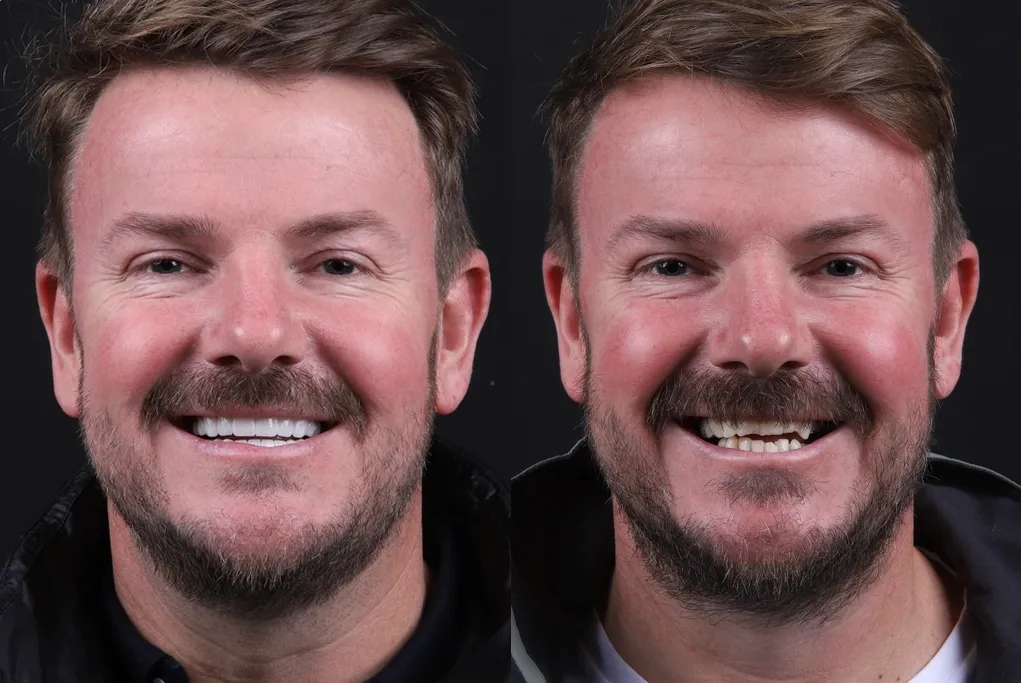 Dental-Crowns