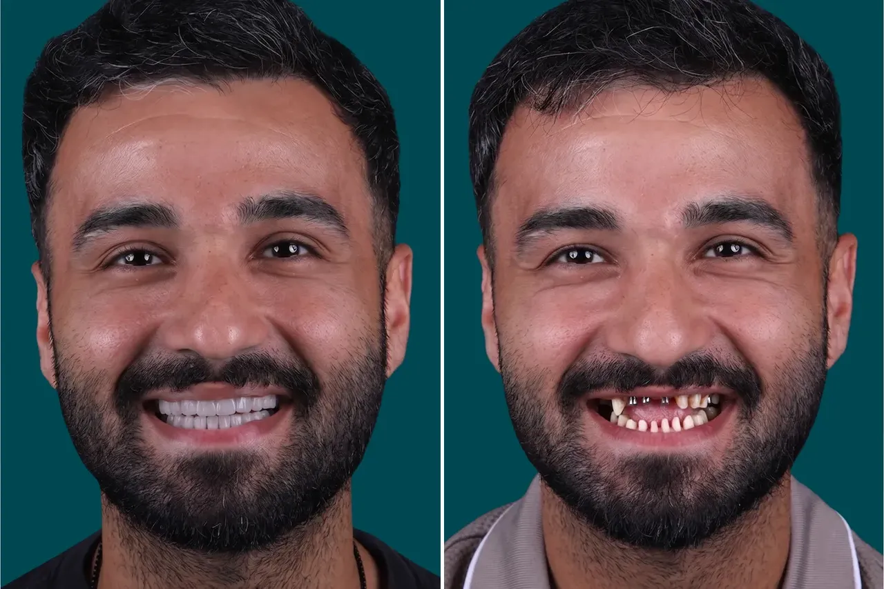 Dental-Implants 1