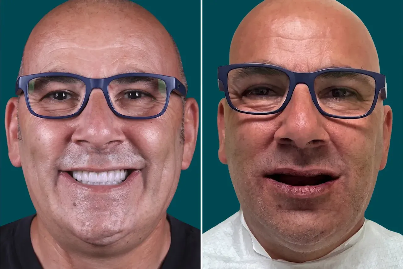 Dental-Implants 2