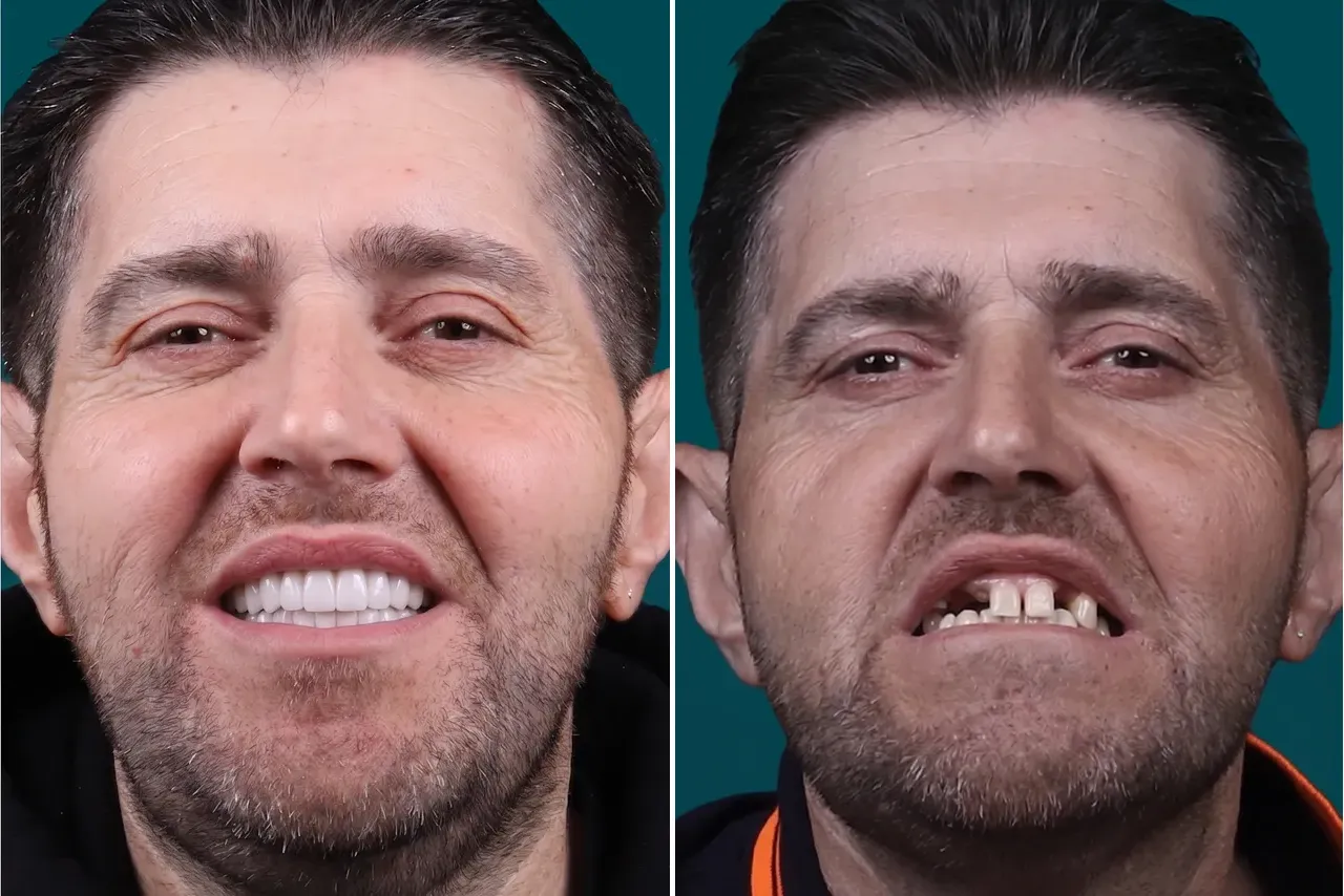 Dental-Implants 3
