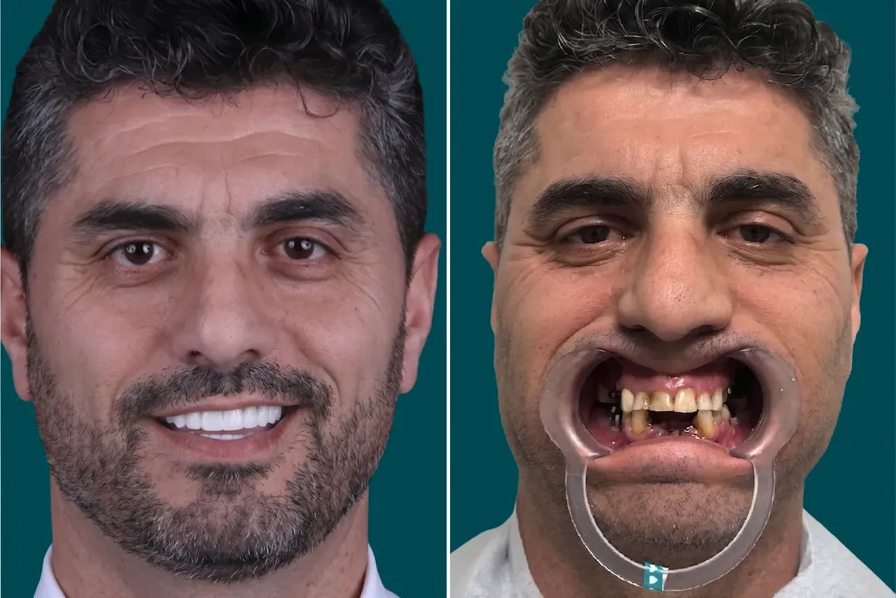 Dental-Implants 4
