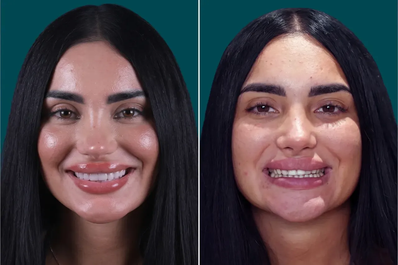 Dental-Veneers 1