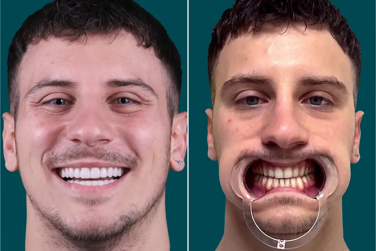 Dental-Veneers 2