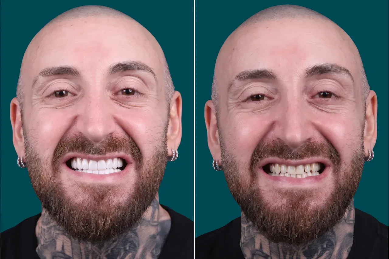 Dental-Veneers 3