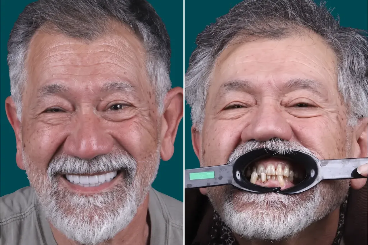Smile-Makeover-Digital Smile Design 4
