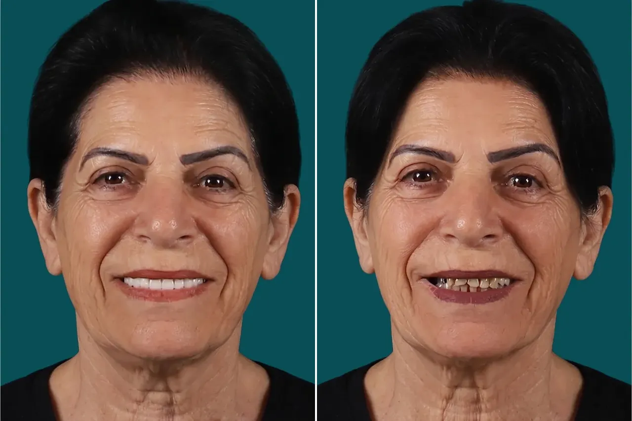 Smile-Makeover-Digital Smile Design 2
