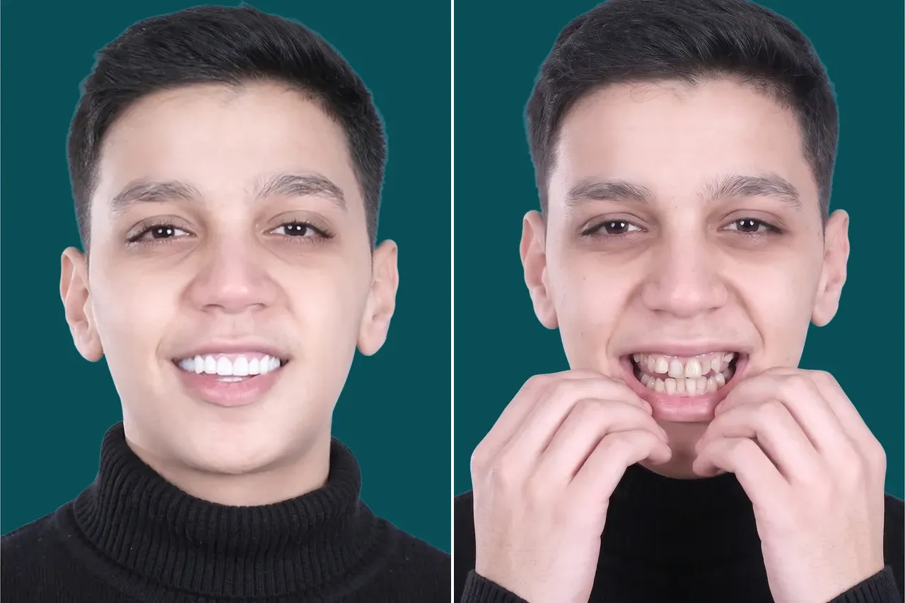 Smile-Makeover-Digital Smile Design 3