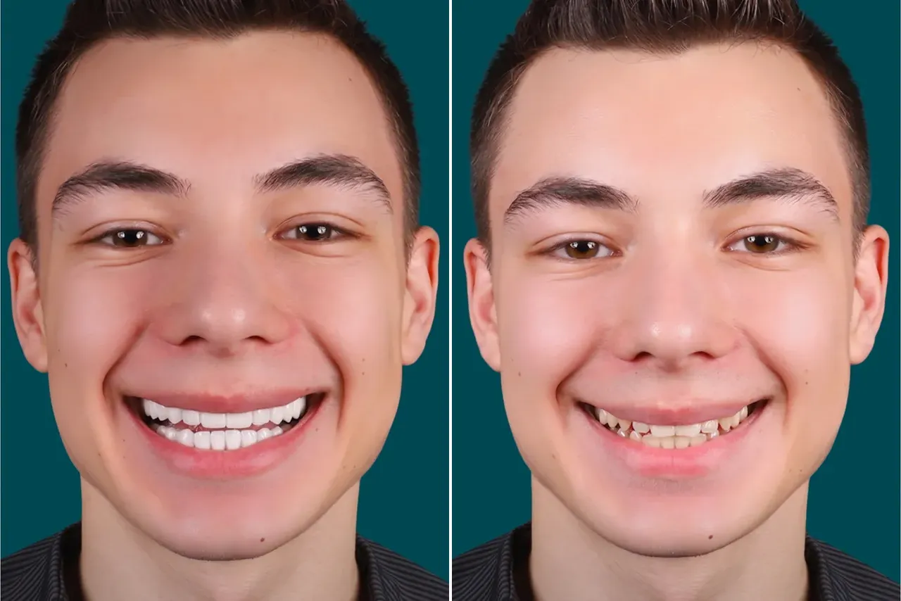 Dental-Crowns- E max Crowns 2