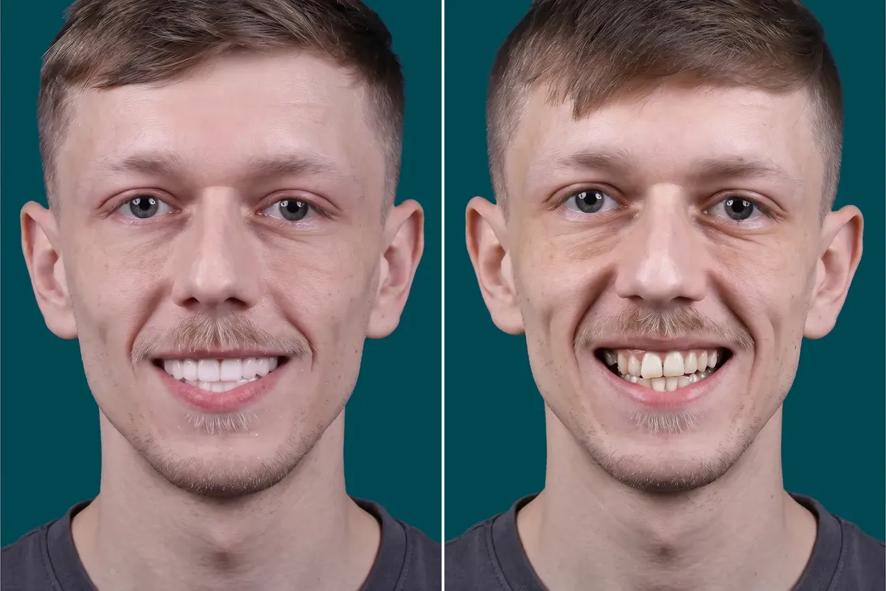 Dental-Veneers- E max veneers 1