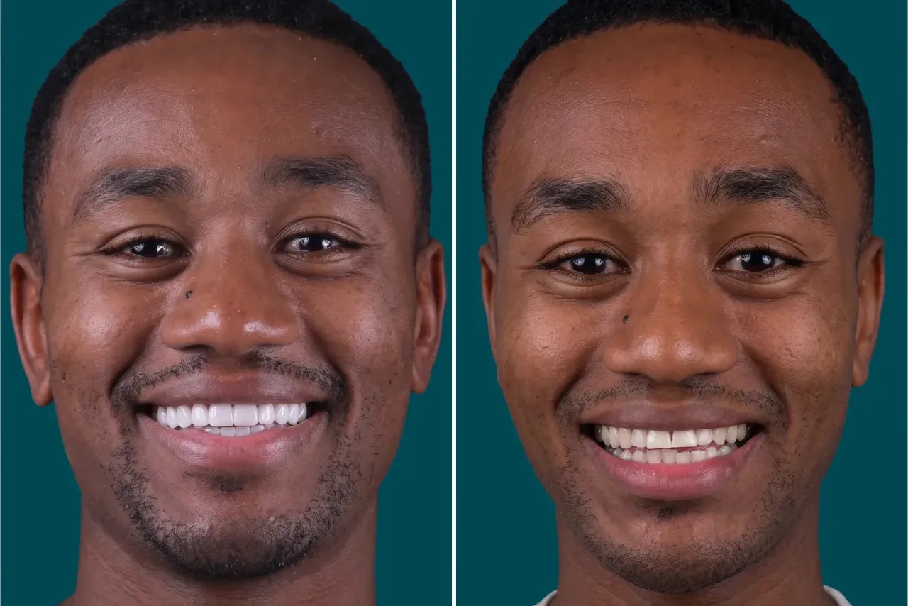 Dental-Veneers- E max veneers 4