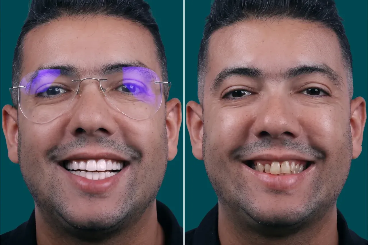 Dental-Veneers- E max veneers 2