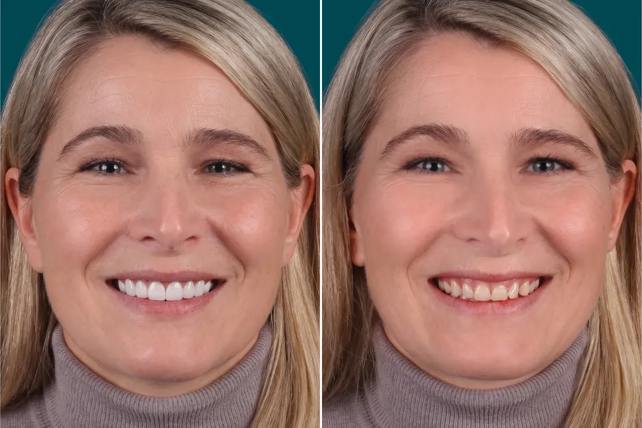 Dental-Veneers- E max veneers 3