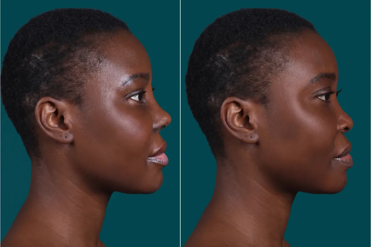 Ethnic Rhinoplasty Before and After 1