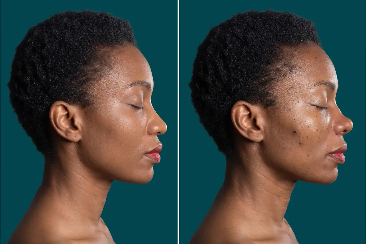 Ethnic Rhinoplasty Before and After 2