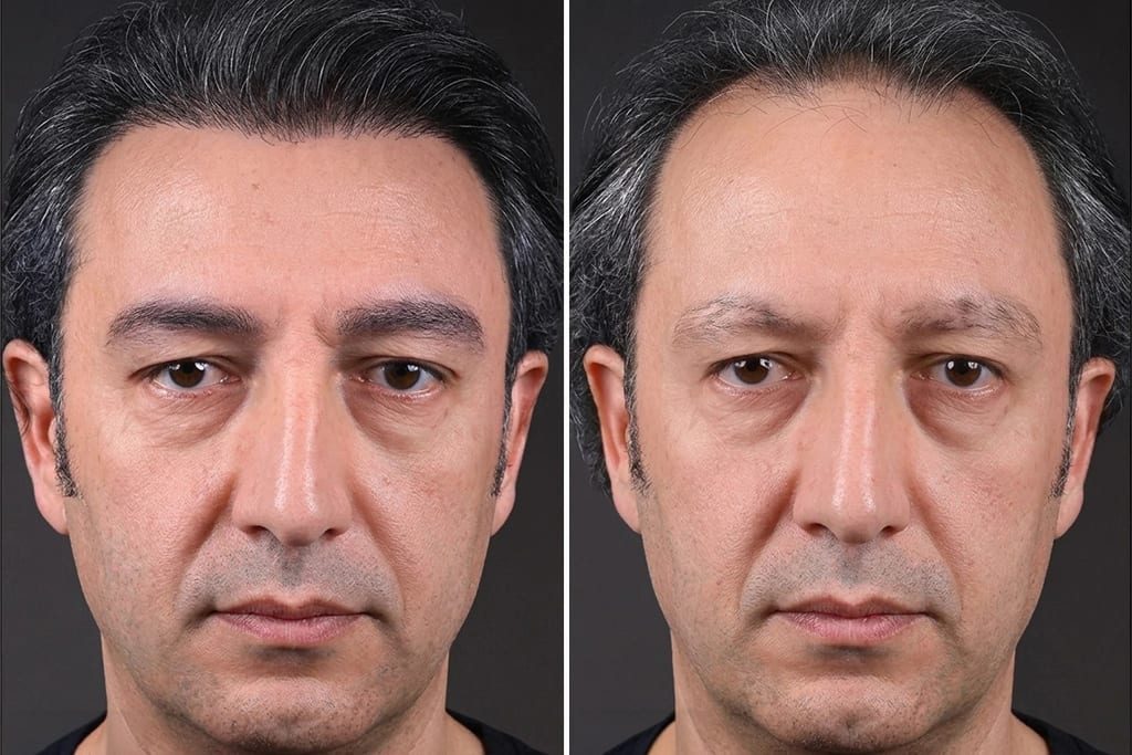Eyebrow Transplant 3
