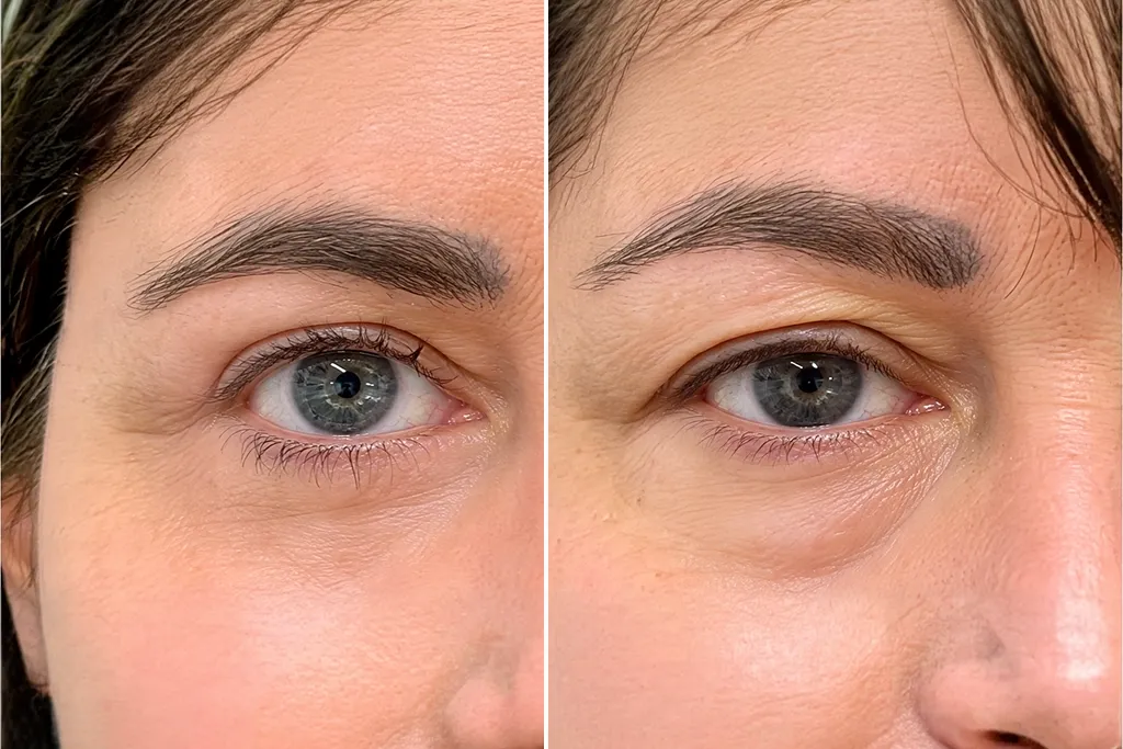 Eyelid Surgery Before After In Turkey 10