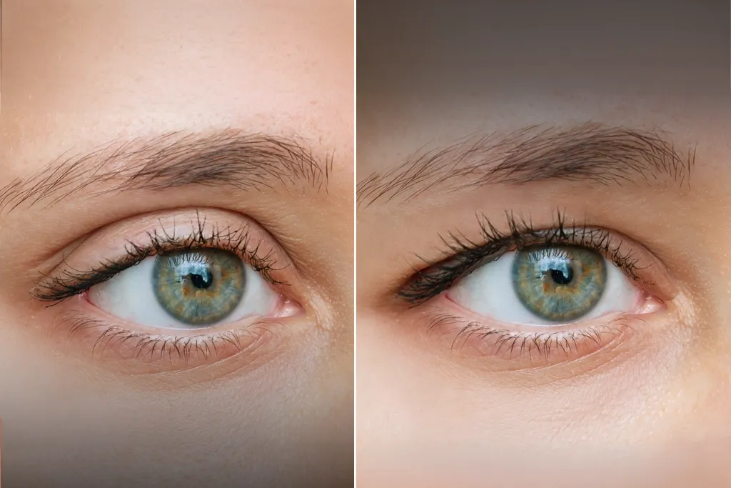 Eyelid Surgery Before After In Turkey 2