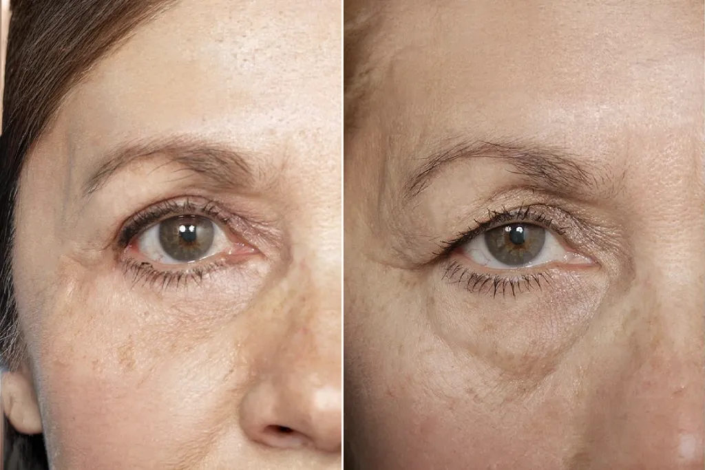 Eyelid Surgery Before After In Turkey 3