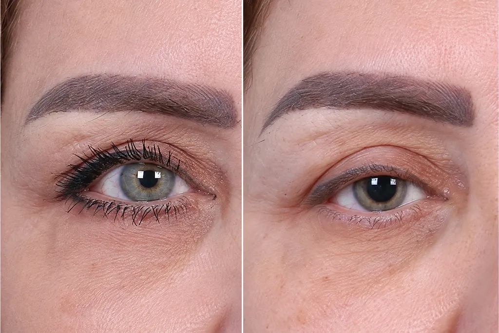Eyelid Surgery Before After In Turkey 5