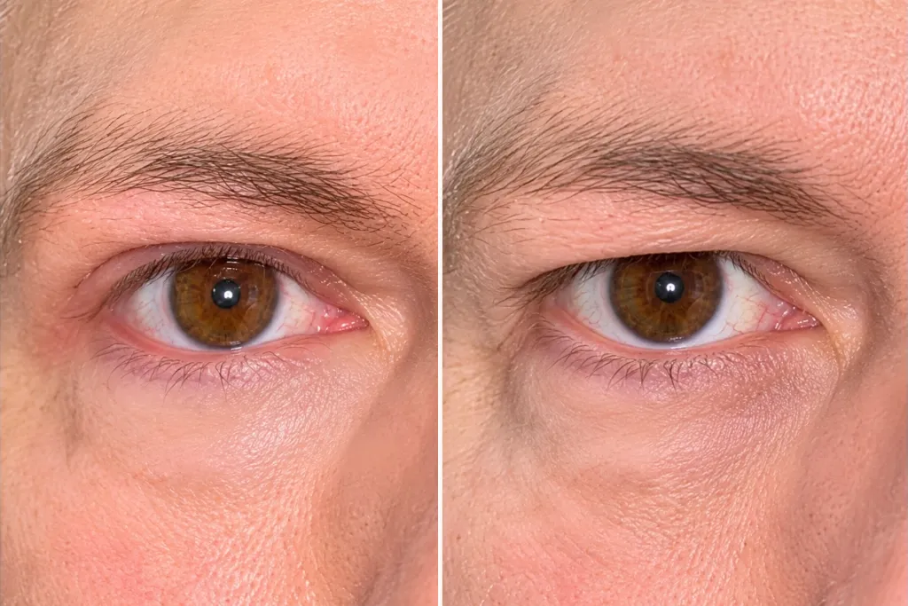 Eyelid Surgery Before After In Turkey 6