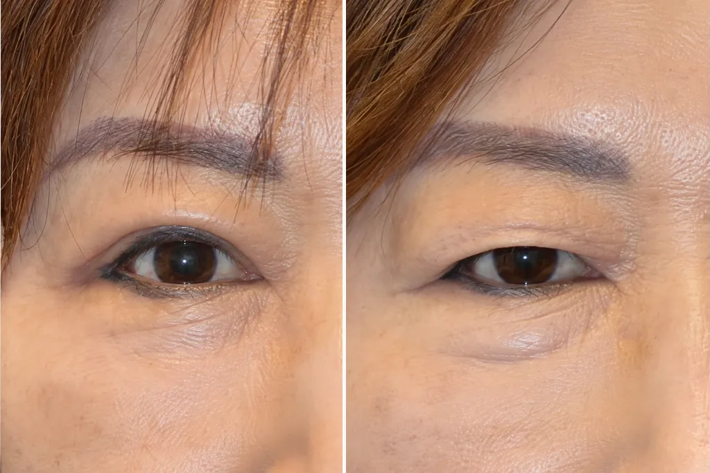Eyelid Surgery Before After In Turkey 9