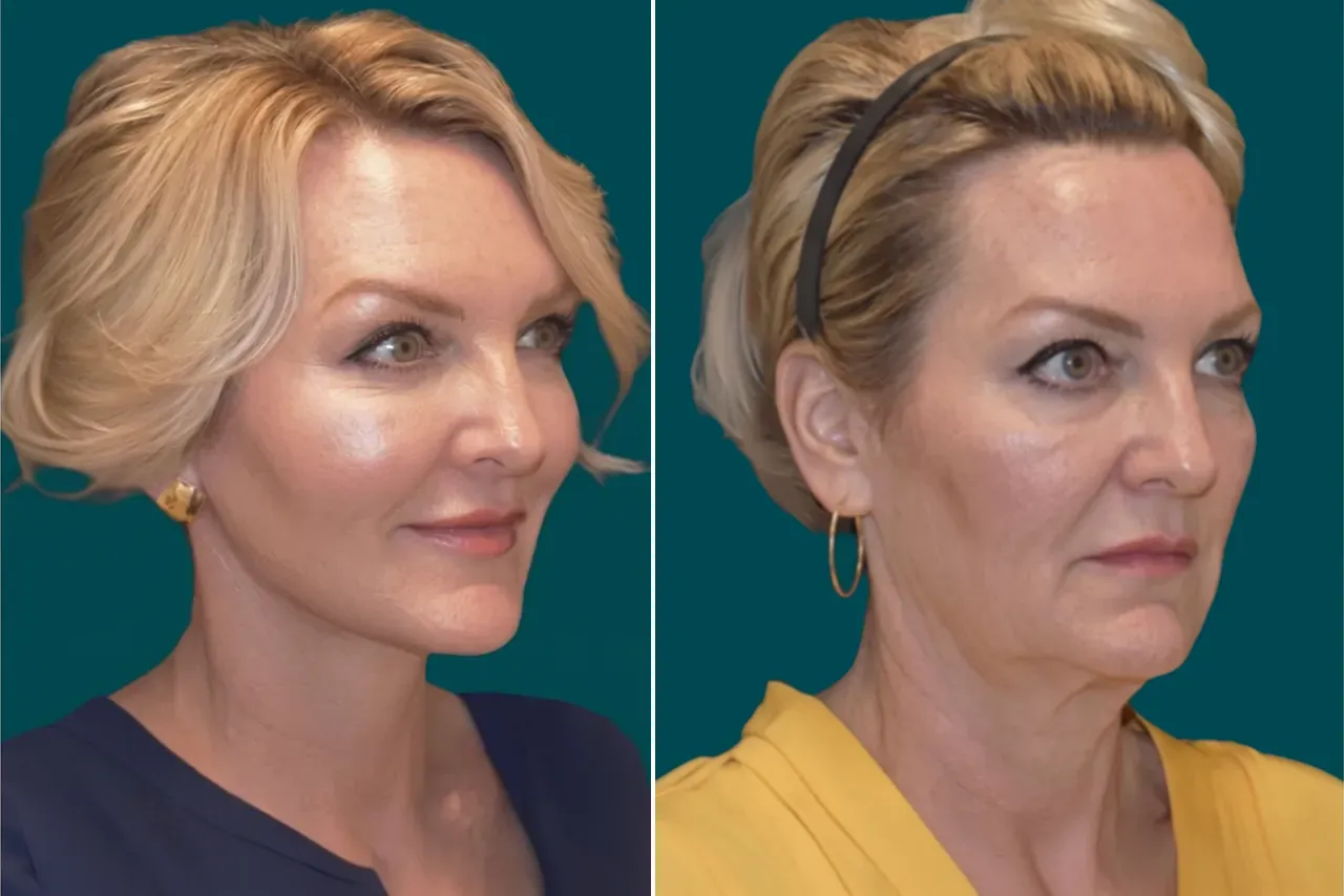 Facelift Before and After 1